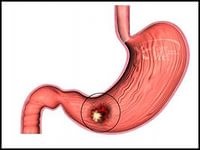 Cum de a vindeca un ulcer gastric cu ser medicinal, medicina populara