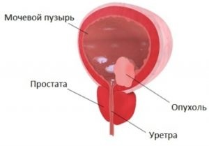 Chirurgia vezicii urinare