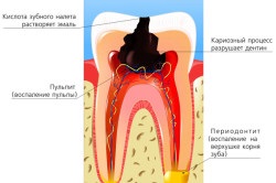 Cyst dinți decât periculoase, simptome și tratament