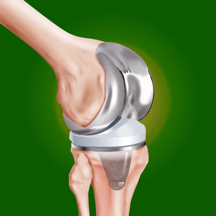 Clinica de artroplastie a genunchiului - operație în ortocentrul clinicii, g