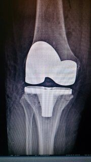 Clinica de artroplastie a genunchiului - operație în ortocentrul clinicii, g