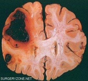 Hemoragie în creier - cauze, simptome, diagnostic, tratament - informații despre neurologie
