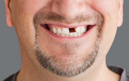 Fumatul este unul dintre motivele care provoacă pierderea dinților - fiți sănătoși