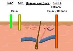 Laserul neodim - tratament corect facial - catalog de articole - cum să fii frumos