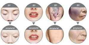 Laserul neodim - tratament corect facial - catalog de articole - cum să fii frumos