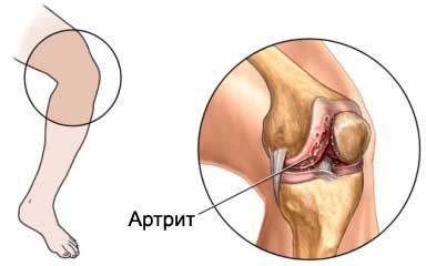 Tratamentul artritei în Novosibirsk - centru medical - tehnologie alfa