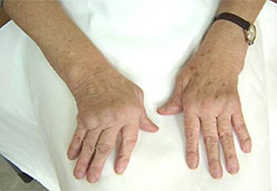 Tratamentul artritei degetelor și degetelor, cauzele și semnele acesteia