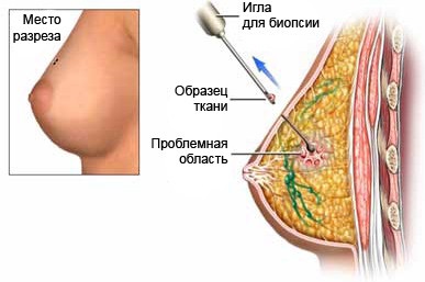 Tratamentul chisturilor mamare cu hormoni și non-hormonali