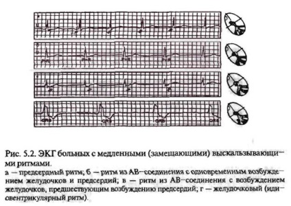 Ritmuri și complexe de alunecare lentă (înlocuire)