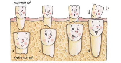 Dentiție dinti la copii cu un model de pierdere, posibile complicații