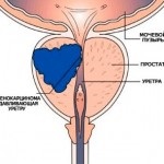 Dacă este posibil la o prostatită răspundem la cele mai importante întrebări