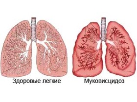 Fibroza chistică - simptome, simptome, tratament, cauze