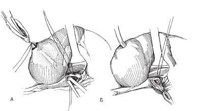 Nefrostomie și ureterostomie