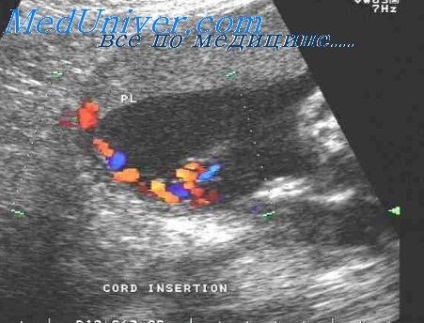 Ophalocele și gastroschisis