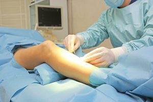 Chirurgie pentru venele varicoase pe picioare sau îndepărtarea venelor în vene varicoase