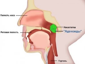 Chirurgie pentru îndepărtarea adenoidelor - bisturiu - informații medicale și portal educațional