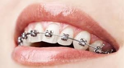 Ortodonție, bretele în Pskov - 