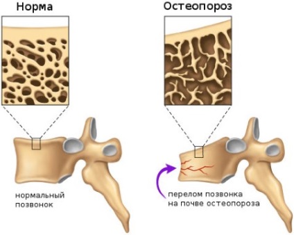 Cauzele osteoporozei, semne, simptome, tratament, la care medicul să contacteze
