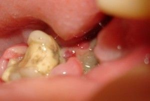 De ce este o acoperire albă pe soclul dintelui îndepărtat