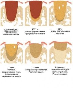 Защо има бял филм на отвора за вадене на зъб