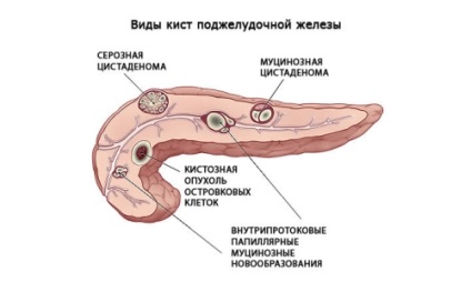 Polyp în cauzele pancreasului, simptome și tratament
