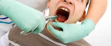 După extracția dinților, dintele vecinul doare