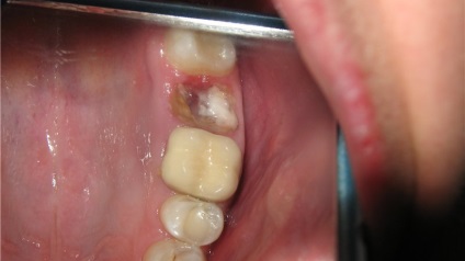 След отстраняването на зъба в нещо на сокет бяло
