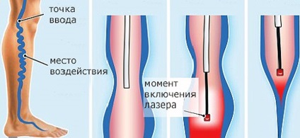 Beneficii de tratament al venelor varicoase pe picioare cu laser, recomandări postoperatorii și preț