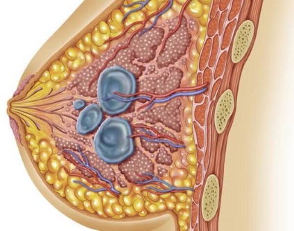 Semnele și tratamentul chisturilor mamare