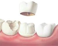 Procesul de fabricare a coroanei dentare