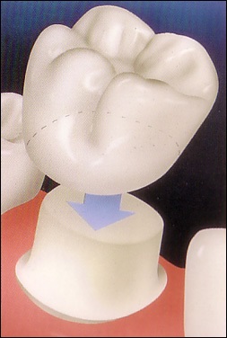 Procesul de fabricare a coroanei dentare