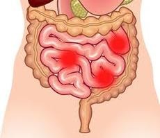 Cancerul ileonului Descrierea bolii, simptome, recomandări de tratament