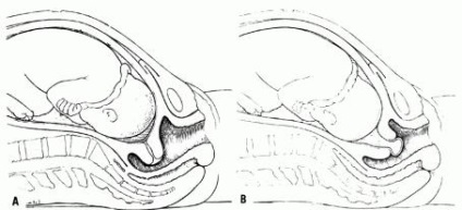 Dezvăluirea cervixului cu 2 degete atunci când apar simptomele dilatării cervicale