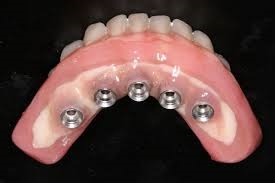 Recomandări după protezele dinților