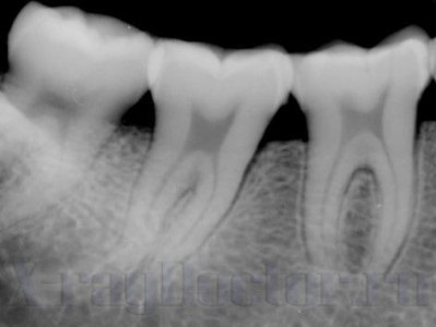 X-ray al maxilarului și al dinților copilului care pot fi văzuți în imagini