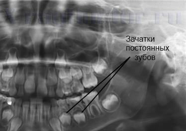 X-ray al maxilarului și al dinților copilului care pot fi văzuți în imagini