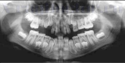 X-ray al maxilarului și al dinților copilului care pot fi văzuți în imagini