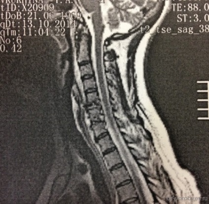 Tratamentul osteocondrozei cervicale, neurochirurgie