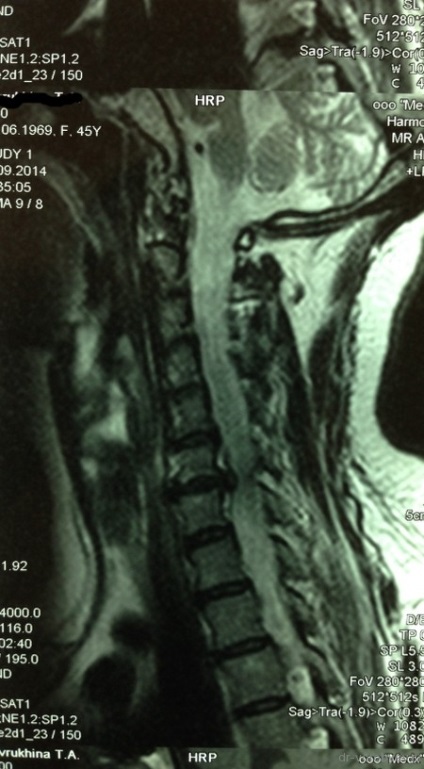 Tratamentul osteocondrozei cervicale, neurochirurgie