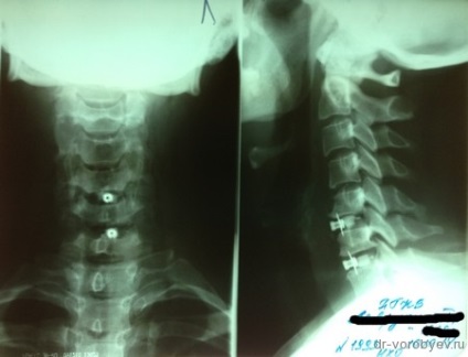 Tratamentul osteocondrozei cervicale, neurochirurgie