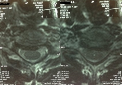 Tratamentul osteocondrozei cervicale, neurochirurgie