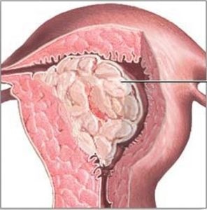 Este hiperplazia endometrială și sarcina compatibile?