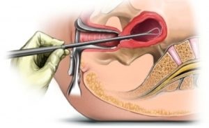 Este hiperplazia endometrială și sarcina compatibile?