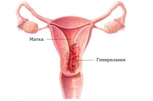 Az endometriális hiperplázia és a terhesség kompatibilis?