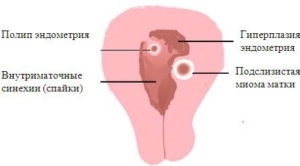 Este hiperplazia endometrială și sarcina compatibile?