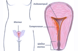 Este hiperplazia endometrială și sarcina compatibile?