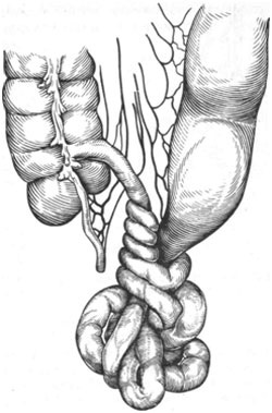 Strangularea nodulării obstrucției intestinale a intestinului