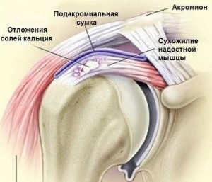 Tendonita supraspinatului a tratamentului articulației umărului, la care medicul să se adreseze