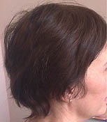 Transplantul de par, o clinică pentru tratamentul alopeciei la Moscova