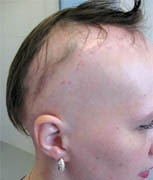 Transplantul de par, o clinică pentru tratamentul alopeciei la Moscova